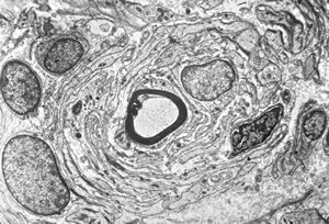 F,12y. | hypertrophic (onion bulb) neuropathy - n.suralis F,12y. | hypertrophic (onion bulb) neuropathy - n.suralis